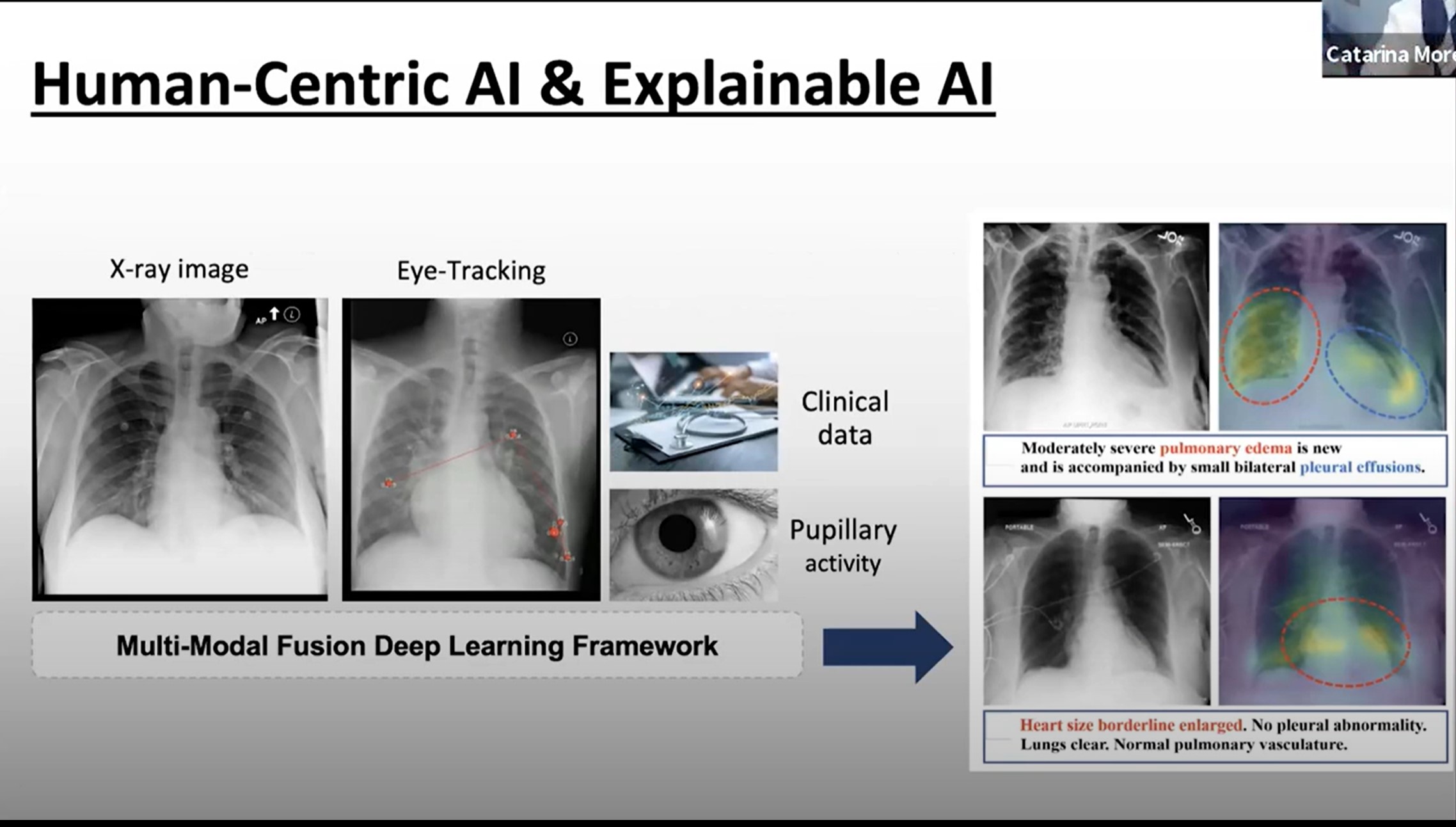 Using a multi-modal approach for machine learning on chest x-rays